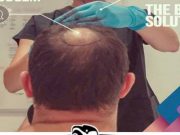 مركز ايستيبيرا يتصدر القائمة الأولى في زراعة الشعر في تركيا